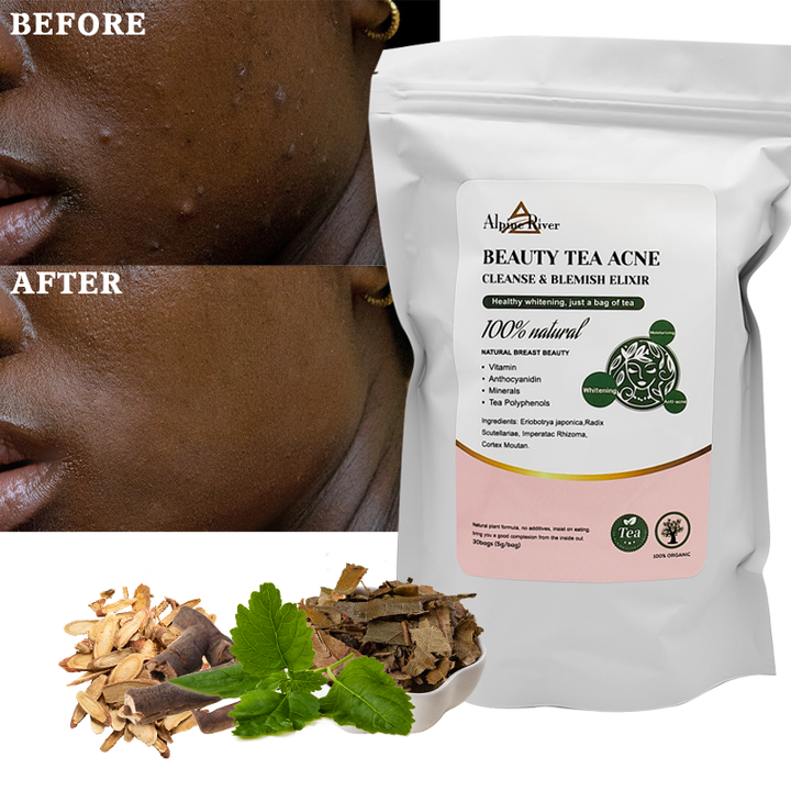 Acne Removal Tea
